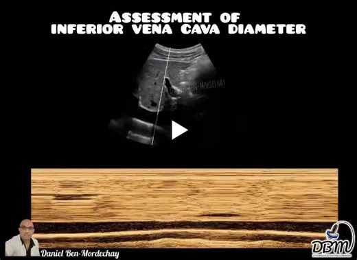 #ultrasound #pocus #ivc #inferiorvenacava #mmode #hemodynamicassessment #volumestatus #criticalcareultrasound #bedsideultrasound #dbm #orimedgtd | Daniel Ben-Mordechay