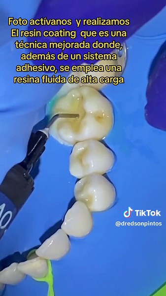 Operatoria dental CLEARFIL™ #SEBOND es un adhesivo de dos pasos compuesto de dos líquidos individuales: el autograbado y el “BOND” fotopolimerizable. La sensibilidad técnica con#clearfilm ™ SE BOND se reduce significativamente, a la vez que proporciona una mayor fuerza de adhesión y propiedades de sellado, considerándose el Estándar de oro de los agentes adhesivos. Permaseal Sellante de composite de alta penetración #Dentista #AislamientoAbsoluto #dredsonpintos #AdhesiónDental #TikTokTutorial #b