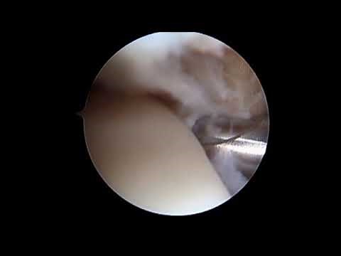 Ankle Arthroscopy Impingement Debridement SFISM