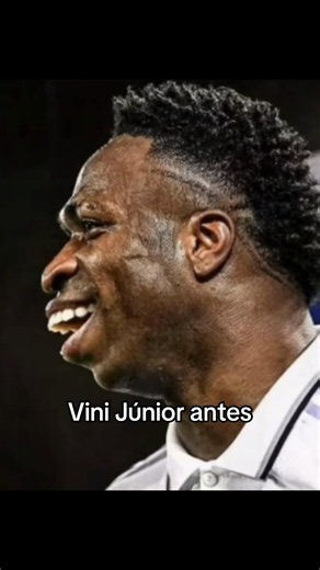 Vinicius Júnior harmonização: antes e depois do novo visual