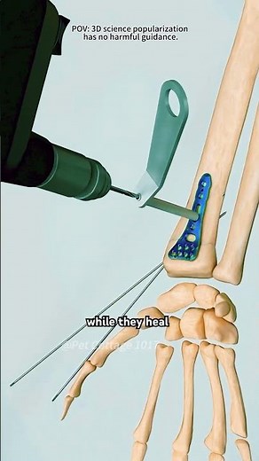 Wrist Fracture Repair Surgery - Distal Radius Fracture(3D Animation)