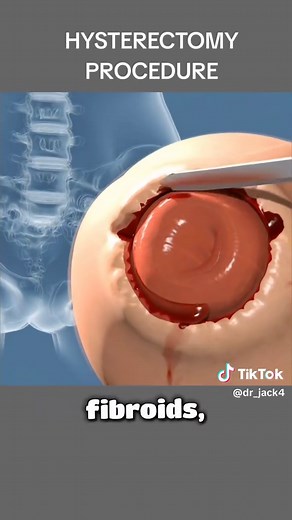 Hysterectomy Procedure Explained | 3D Medical Animation #Hysterectomy #WomensHealth #MedicalAnimation #SurgeryExplained #3DAnimation #HealthEducation #Gynecology