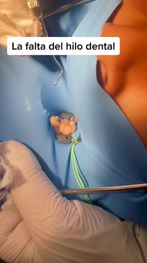 Tratamiento de Pulpotomía en Niños: Proceso y Cuidados