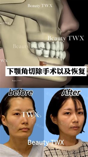 Mr.Davide on Instagram: "Comparison of the effect before and after mandibular angle surgery! The lady's face is very smooth！ #plastic #整形 #医美 #Grind bone#Mandibular angle#Orthognathic surgery"