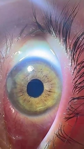 Video 2 of repetitive constriction and dilatation of pupil under constant illumination.