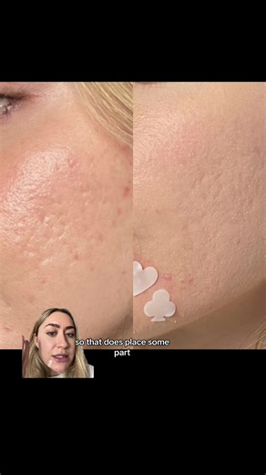 Effective Laser Treatment for Acne Scars