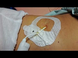 引流管消毒換藥