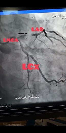 Blockage in the left anterior descending (90% LAD blockage )