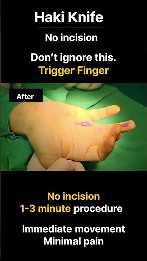 (Incredible!) Right Ring Trigger Finger: No More Clicking or Popping. #triggerfinger #handsurgery