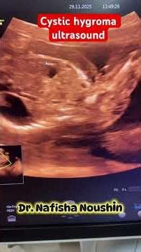 Cystic hygroma ultrasound #ultrasound ,#anomalyscan