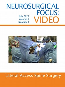 Minimally invasive lateral retroperitoneal transpsoas approach for lumbar corpectomy and fusion with posterior instrumentation