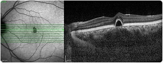 What is Optical Coherence Tomography?