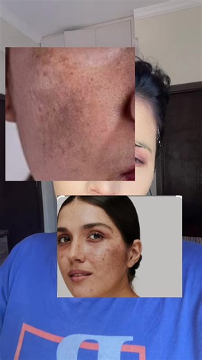 Effective Home Remedies for Pigmentation and Melasma