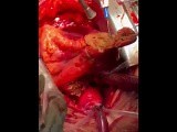 Extensive Resection of Heart Tumor by CPB  • Video • MEDtube.net