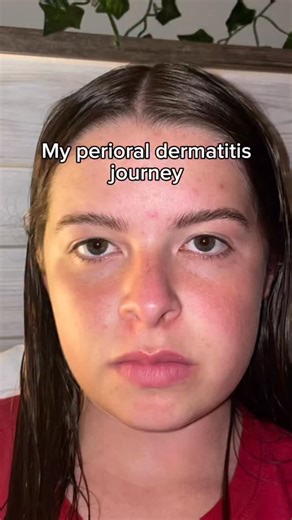 Alexa Martin on Instagram: "This is very hard for me to post but I want people going through the same thing to know you’re not alone! I know how lonely you can feel when going through something like this but I promise there’s light at the end of the tunnel. These are all the things I did that I believe helped heal my PD at the root cause⬇️ 1. Simplified skincare: I only used water and applied the Badgers baby diaper rash cream morning and night to help relive itching and burning. No retinols, mo