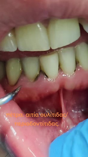 Προληπτικός καθαρισμός: Αιτίες ουλίτιδας και περιοδοντίτιδας