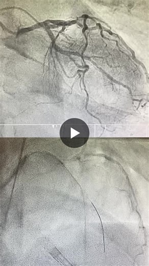 #interventionalcardiology #highriskpci #leftmainpci #impella #nstemi #complexpci #heartfailure #coronaryarterydisease | Elnur Bakirov