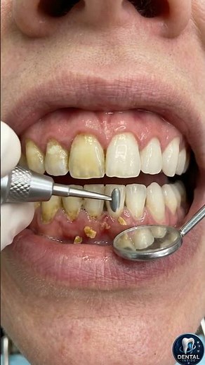 How Yellow Teeth Are Cleaned 🦷 Plaque and Stain Removal Explained