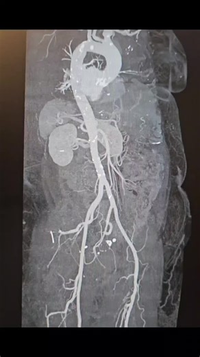 We performed a TAVI procedure on our patient with severe aortic stenosis on the basis of a type 2 bicuspid valve. Although the valve anatomy made it challenging to reach the optimal position, after… | Samet Uysal