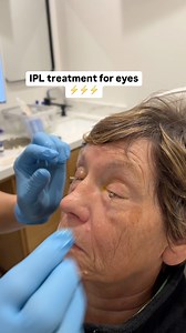 Intense Pulsed Light (IPL) therapy is a treatment for dry eye disease that uses pulses of light to improve the function of the meibomian glands, which produce the oily layer of tears 💧💧💧💦💦💦 📍979 Story Road, Ste 7009, San Jose, CA 95122 ☎️ (408)-900-2000 📍 2063 Camden Ave, San Jose, CA 95124 ☎️ (408)-377-1479 📍6815 Camino Arroyo, Ste 60 - Gilroy, CA 95020 ☎️ (408)-842-0101 #eyeexam #eyecare #eyecaretips #eyecarecenter #optometry #eyecheckup #eyeclinic #healthyeyes #contactlenses #glasses