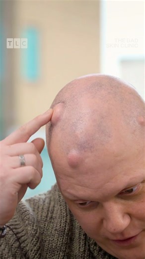 �A perfect pilar cyst removal! ✨ #TheBadSkinClinic starts tonight at 9pm on TLC | TLC UK