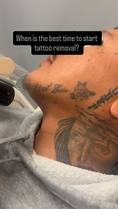 237 reactions · 9 comments | When is the best time to start tattoo removal? The best time to start is whenever you are ready. Multiple sessions are needed for full removal. #lasertattooremoval #facetattoos #757 | Atlantic Laser Tattoo Removal | Facebook