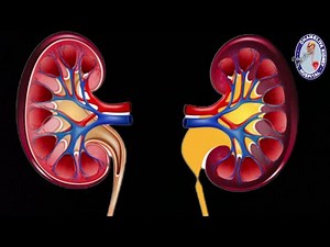 Pyeloplasty surgery| Ureteropelvic Junction Obstruction|(UPJ)| Dhameliya Kidney Hospital