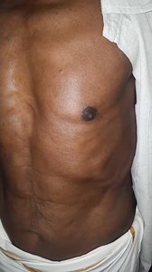 Visible apex beat #medicine #cardiology #clinical #medicalpanch