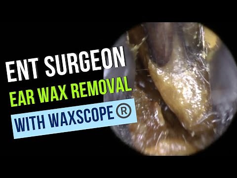 04 - ENT Surgeon Ear Wax Removal
