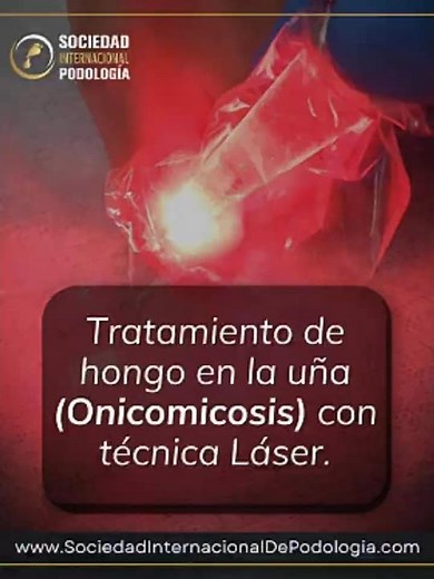 🔬 Tratamiento de Onicomicosis con Láser | Innovación Real en Podología Clínica 👣✨