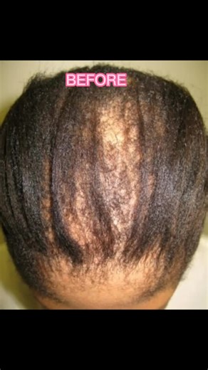 #hairgrowthhacks #hairgrowthserum #hairgrowthoil #hairgrowthproducts