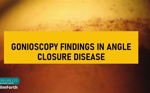 Gonioscopy in Narrow Angles - 房角镜检查：窄角疾病表现