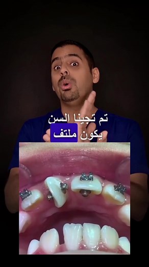 علاج الأسنان الملتفة بالتقويم بطريقة بسيطة