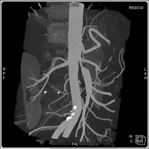 SMA dissection MIP2 | CTisus: Cutting edge information on body CT (Computed tomography).