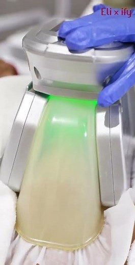 Cryolipolysis, commonly referred to as fat freezing procedure