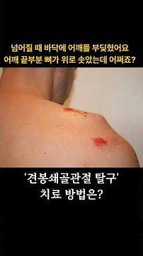 견봉쇄골관절 탈구, 어떤 수술을 해야되나요?