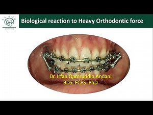 Biological Response of PDL to Heavy Orthodontic force