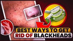 6 Best Ways To Get Rid Of Blackheads Fast