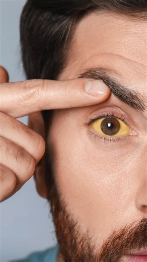 When Grade 2 fatty liver progresses to Grade 3 (Severe Steatosis), fat occupies over 66% of the organ, causing significant dysfunction. Symptoms intensify as a result of extreme inflammation: severe fatigue, intense RUQ pain, pronounced jaundice, and abdominal swelling (ascites). You may also experience nausea, mental confusion, itchy skin, dark urine, leg edema, and spider angiomas. This stage requires immediate intervention to prevent irreversible scarring or liver failure. #FattyLiver #Grade3