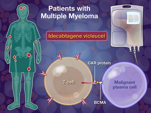 The CAR T-cell therapy ide-cel is approved in the U.S. for relapsed or refractory multiple myeloma after the receipt of at least four previous lines of therapy. Its efficacy earlier in treatment is unknown. Research findings are summarized in a video. https://nej.md/40yOq2w | The New England Journal of Medicine