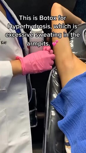 Stay confident and sweat-free all day long with our Botox treatment for underarm hyperhidrosis! 💦🙋🏼 Excessive sweating under the arms, also known as axillary hyperhidrosis, can be an uncomfortable and embarrassing for some. Botox, however, can help! Botox works to temporarily block the chemical signals from the nerves that stimulate the sweat glands. This results in reduced sweating. It’s a safe, effective, and minimally invasive option that can last up to 6 months! Call our office to book yo