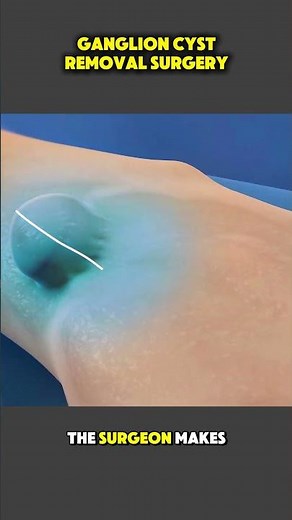 How Ganglion Cyst Removal Surgery Is Done | Step-by-Step Surgical Guide #GanglionCyst #WristSurgery