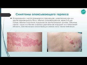 Опоясуючий герпес (лишай): симптоми та лікування. Препарати та мазі від опоясуючого лишаю