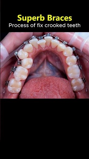 Superb braces: Process of fix extremely crooked teeth #braces #orthodontics #dentist #brackets