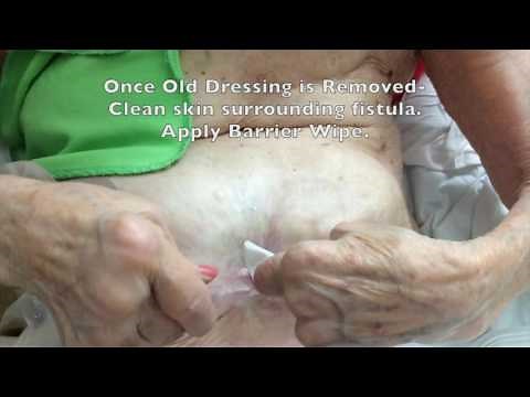 Enterocutaneous High Output Fistula Wound Management