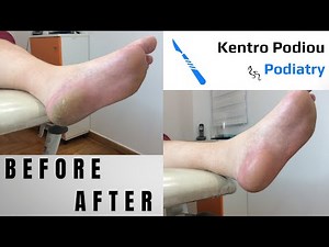 Hard skin|Σκληρύνσεις|Σκασμένες φτέρνες|Ποδιατρική Ποδολογία|Κέντρο Ποδιού Podiatry|Podiatrist