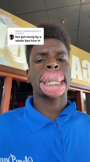 Man with Big Lips Stung by a Bee Reaction Video | Funny Guy Getting Stung