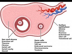 Sex cord stromal tumors of Ovary; Granulosa tumors, Fibroma, Fibrothecoma, Thecoma, Sertoli cell