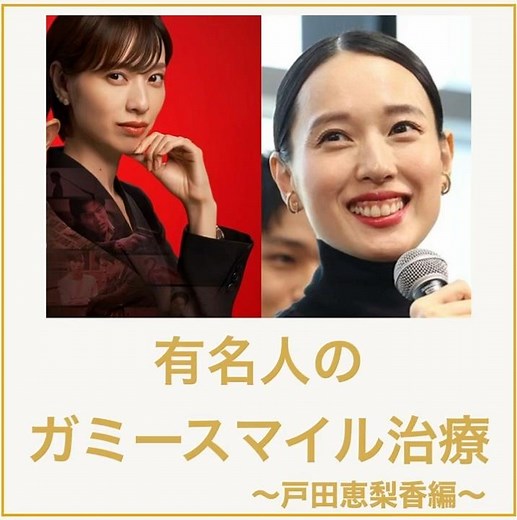 芸能人のガミースマイル治療〜戸田恵梨香編〜