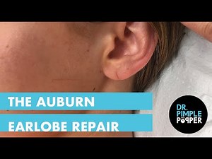 The Auburn Earlobe Repair